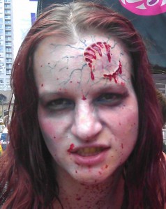 Human Bite Wound